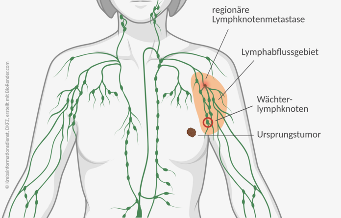 Wächterlymphknoten, © Krebsinformationsdienst, DKFZ; erstellt mit BioRender.com Grafische Darstellung eines Oberkörpers mit Lymphsystem. Ein Hauttumor und Tumorabsiedlungen (Metastasen) sind zu sehen.
