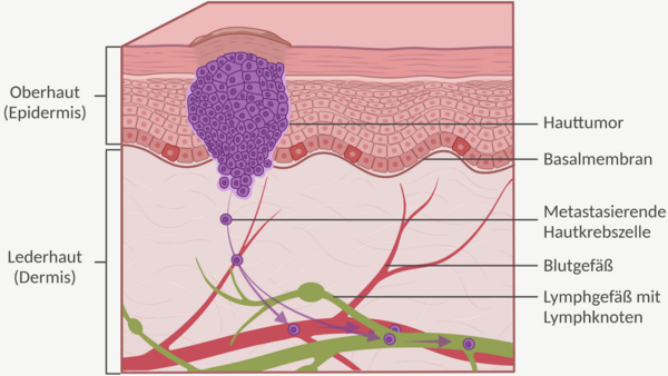 Grafische Darstellung der Haut im Querschnitt. Abgebildet und beschriftet sind die Oberhaut (Epidermis) mit den verschiedenen Schichten Lederhaut (Dermis) und die Unterhaut (Subcutis) mit Lymph- und Blutgefäßen. In der Oberhaut ist ein Hauttumor abgebildet, von dem sich einzelne Krebszellen gelöst haben und das Blut-und Lymphgefäß erreicht haben.