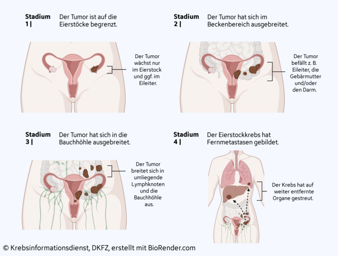 Eierstockkrebs-Stadieneinteilung, © Krebsinformationsdienst, DKFZ; erstellt mit Biorender.com Grafische Darstellung der Stadieneinteilung bei Eierstockkrebs – Stadium 1: Der Tumor ist auf die Eierstöcke begrenzt, Stadium 2: Der Tumor hat sich im Beckenbereich ausgebreitet, Stadium 3: Der Tumor hat sich in die Bauchhöhle ausgebreitet, Stadium 4: Der Eierstockkrebs hat Fernmetastasen gebildet.