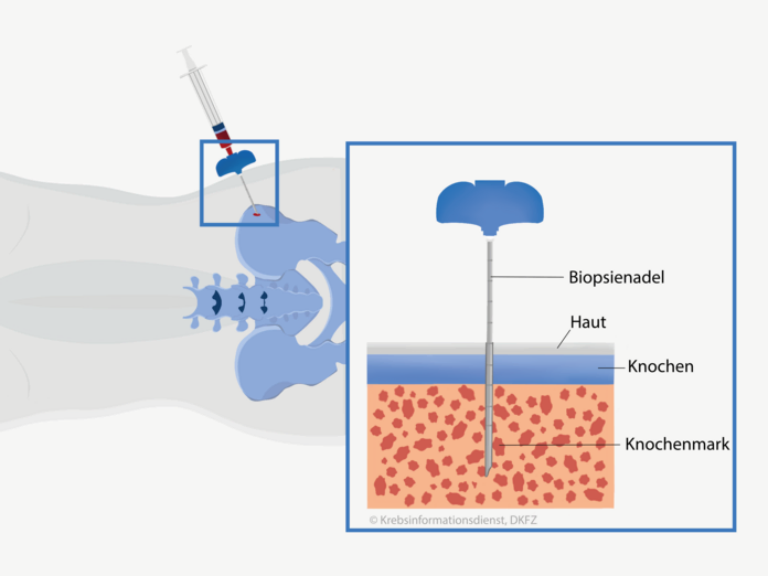 Grafische Darstellung der Knochenmarkaspiration, Asena Tunali © Krebsinformationsdienst, DKFZ Bei der Knochenmarkuntersuchung wirde eine Biopsienadel durch die Haut in den Beckenknochen gestochen und das Knochenmark angesaugt.