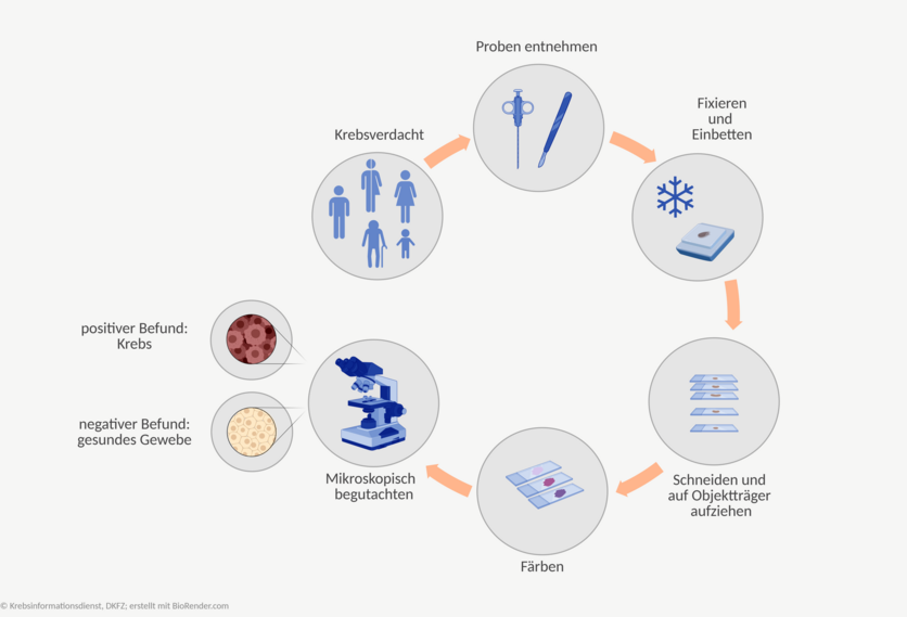 Ablaufschema einer histologischen Untersuchung: Besteht der Verdacht auf eine Krebserkrankung, wird der oder dem Betroffenen Gewebeproben entnommen. Die Proben werden fixiert, eingebettet, in hauchdünne Scheiben geschnitten und auf Objektträger aufgebracht. Anschließend werden die Proben gefärbt und unter dem Mikroskop begutachtet. Sind die Zellen gesund, ist der Befund negativ. Handelt es bei dem Gewebe um Krebs, ist der Befund positiv.
