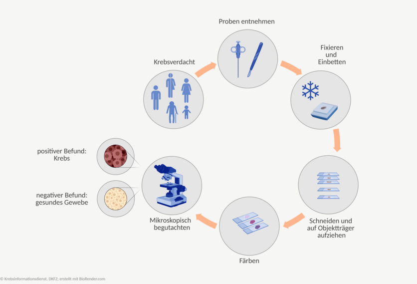 Ablaufschema einer histologischen Untersuchung: Besteht der Verdacht auf eine Krebserkrankung, wird der oder dem Betroffenen Gewebeproben entnommen. Die Proben werden fixiert, eingebettet, in hauchdünne Scheiben geschnitten und auf Objektträger aufgebracht. Anschließend werden die Proben gefärbt und unter dem Mikroskop begutachtet. Sind die Zellen gesund, ist der Befund negativ. Handelt es bei dem Gewebe um Krebs, ist der Befund positiv.