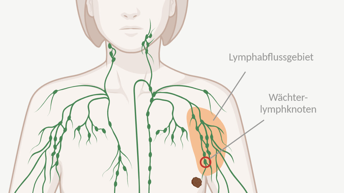 Brustkrebs Lymphknoten Nicht Befallen Trotzdem Metastasen www.krebsinformationsdienst.de