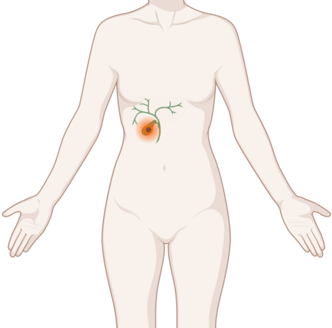 Schematische, anatomische Darstellung der Gallenblase und Gallengänge mit leuchtendem Tumor