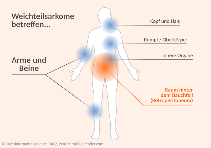 Bei einer menschlichen Silhouette sind mehrere Körperbereiche markiert: Arme und Beine, Kopf und Hals, Rumpf, Innere Organe, Retroperitoneum (Raum hinter dem Bauchfell). Das Retroperitoneum ist farblich hervorgehoben.