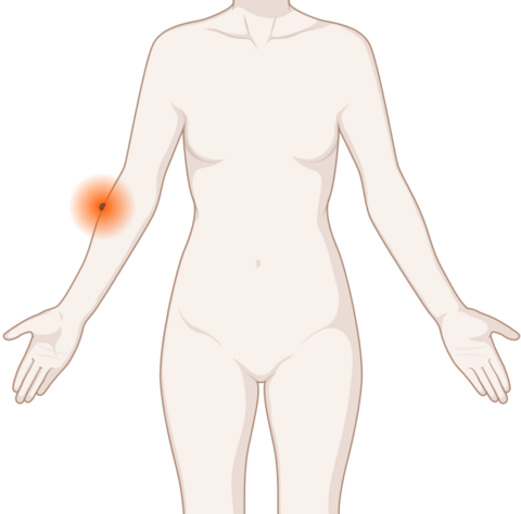 Hautkrebs, © Krebsinformationsdienst, DKFZ; erstellt mit Biorender.com Schematische, anatomische Darstellung der Haut mit leuchtendem Tumor