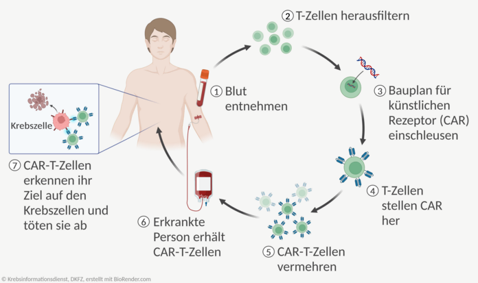 CAR-T-Zelltherapie, © Krebsinformationsdienst, DKFZ, angepasst nach "Chimeric Antigen Receptor (CAR) T Cell Therapy: Vein-to-Vein Process" von BioRender.com (2024), abgerufen von https://app.biorender.com/biorender-templates Ablauf einer CAR-T-Zell-Therapie