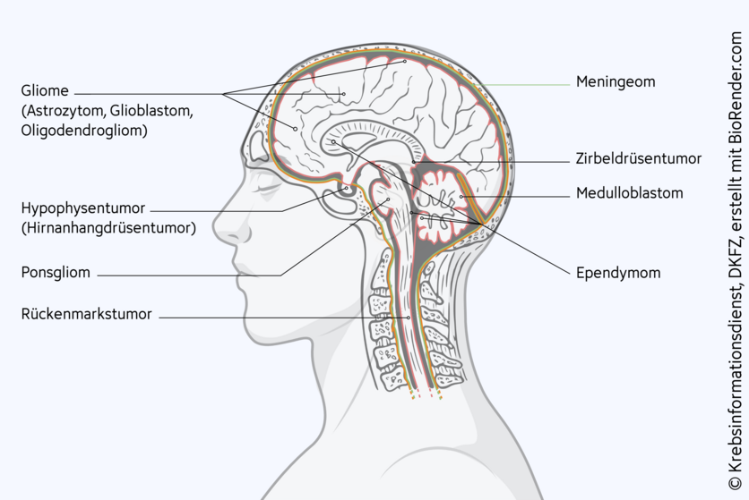 Es gibt verschiedene Arten von Hirntumoren, die in unterschiedlichen Bereichen des Gehirns entstehen können, unter anderem Gliome, Meningeome, Neurinome oder Rückenmarkstumoren.