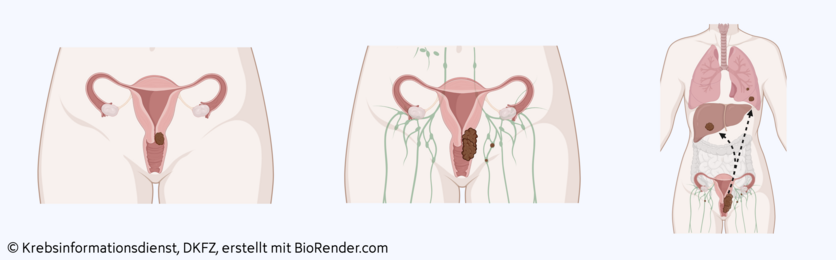 Anatomische Darstellung eines örtlich begrenzten Tumors, örtlich fortgeschrittenen Tumors und Fernmetastasen bei Gebärmutterhalskrebs.