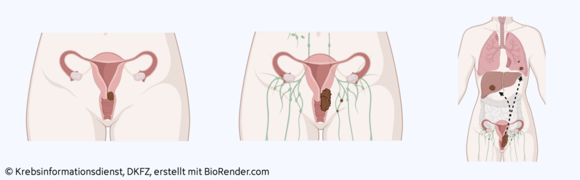 Anatomische Darstellung eines örtlich begrenzten Tumors, örtlich fortgeschrittenen Tumors und Fernmetastasen bei Gebärmutterhalskrebs.