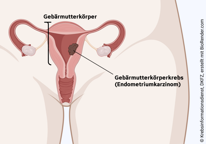 gebaermutterkoerperkrebs, endmetriumkarzinom, Krebsinformationsdienst, DKFZ, erstellt mit BioRender.com Schematische Darstellung der weiblichen Geschlechtsorgane mit Tumor im Gebärmutterkörper.
