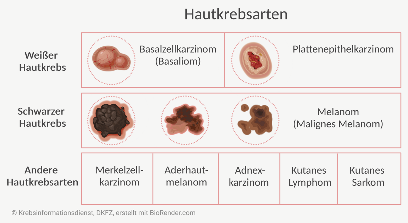 Weißer Hautkrebs, Melanom: Entstehung und Prognose | DKFZ