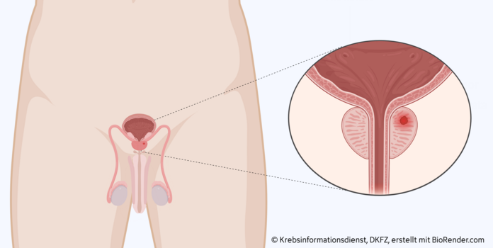 Grafische Darstellung der Lage der Geschlechtsorgane, Harnblase, Harnröhre. In der Prostata befindet sich ein Tumor (rot).