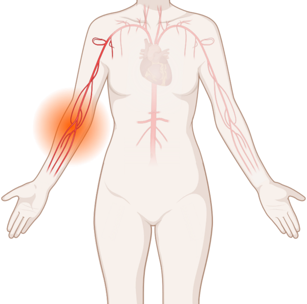 Schematische, anatomische Darstellung von Blutgefäßen mit leuchtendem Tumor.