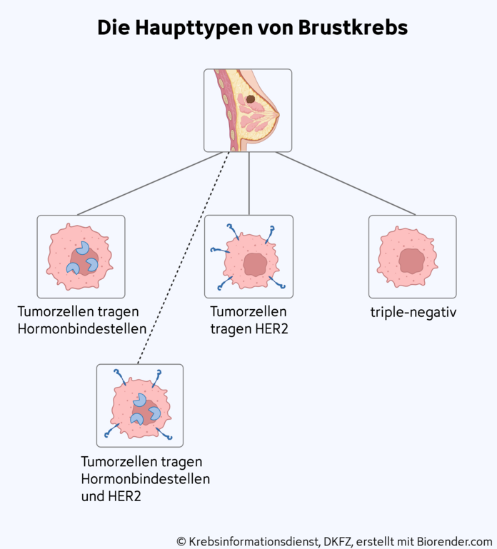 Die 3 Haupttypen von Brustkrebs, © Krebsinformationsdienst, DKFZ; erstellt mit BioRender.com Grafische Darstellung einer Brust mit einem Tumor. Darunter Tumorzellen mit 1) Hormonbindestellen 2) HER2-Eiweiß 3) ohne diese Merkmale 4) mit beiden Merkmalen