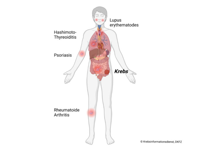 Grafik einer Person mit Darmkrebs, die beispielhaft mehrere Autoimmunerkrankungen zeigt.