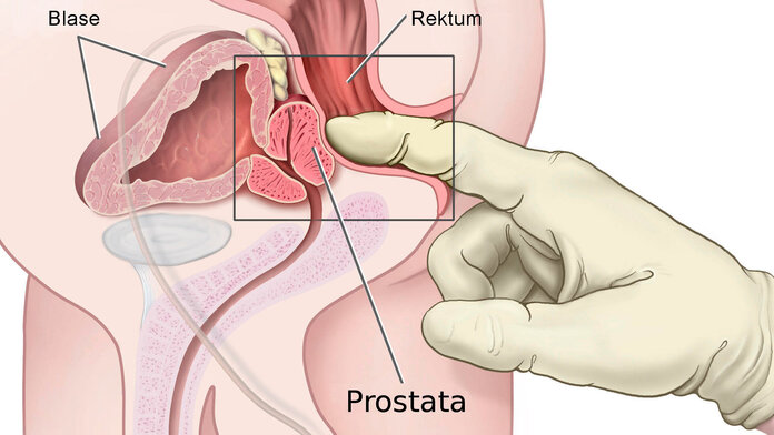 Anatomische Darstellung, wie der Finger eines Arztes die Prostata über den Enddarm (Rektum) abtastet.
