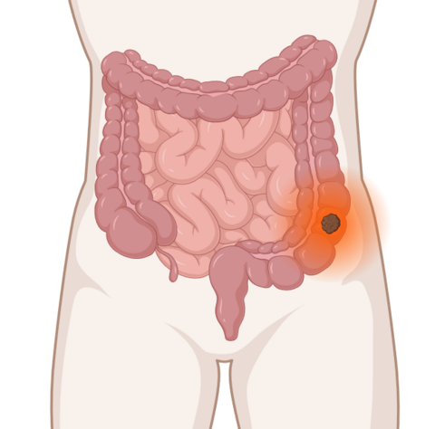 Darmkrebs: anatomische Darstellung mit leuchtendem Tumor