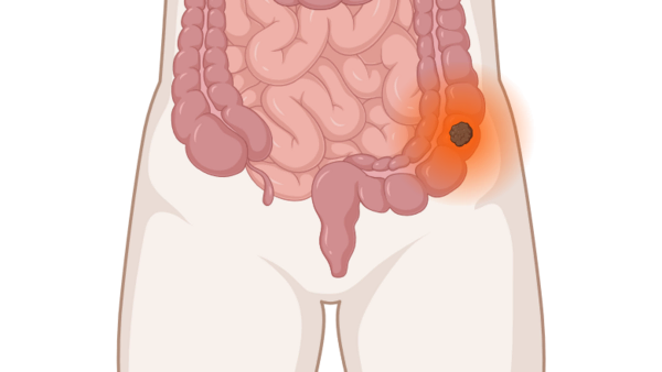 Darmkrebs, © Krebsinformationsdienst, DKFZ; erstellt mit BioRender.com Darmkrebs: anatomische Darstellung mit leuchtendem Tumor