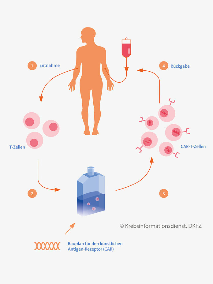 Ablauf einer CAR-T-Zell-Therapie Für die CAR-T-Zell-Therapie werden T-Zellen aus den Blut des Patienten gewonnen, im Labor gentechnisch verändert und dann wieder dem Patienten zurückgegeben.
