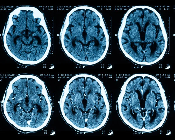 Computertomographie mit und ohne Kontrastmittel , © Suttha Burawonk, Shutterstock Aufnahme einer Computertomographie des Gehirns: oben ohne und unten mit Kontrastmittel.