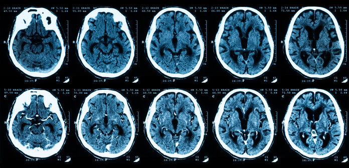 Computertomographie mit und ohne Kontrastmittel , © Suttha Burawonk, Shutterstock Aufnahme einer Computertomographie des Gehirns: oben ohne und unten mit Kontrastmittel.