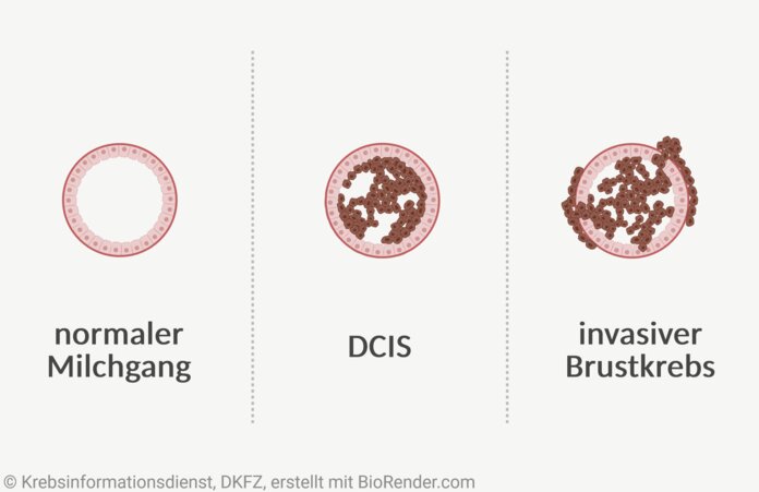 Duktales Karzinom in situ (DCIS), © Krebsinformationsdienst, DKFZ; erstellt mir Biorender.com Abgebildet sind Querschnitte eines Milchgangs im Vergleich: normaler Milchgang, DCIS und invasiver Brustkrebs. Bei einem DCIS wachsen die veränderten Zellen nur im Milchgang, bei einem invasiven Brustkrebs durchbrechen sie die Gewebegrenze.