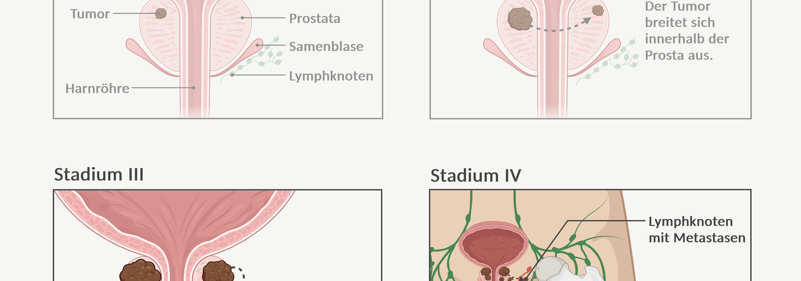 Prostatakrebs: lokal fortgeschritten und mit Metastasen | DKFZ -  Krebsinformationsdienst