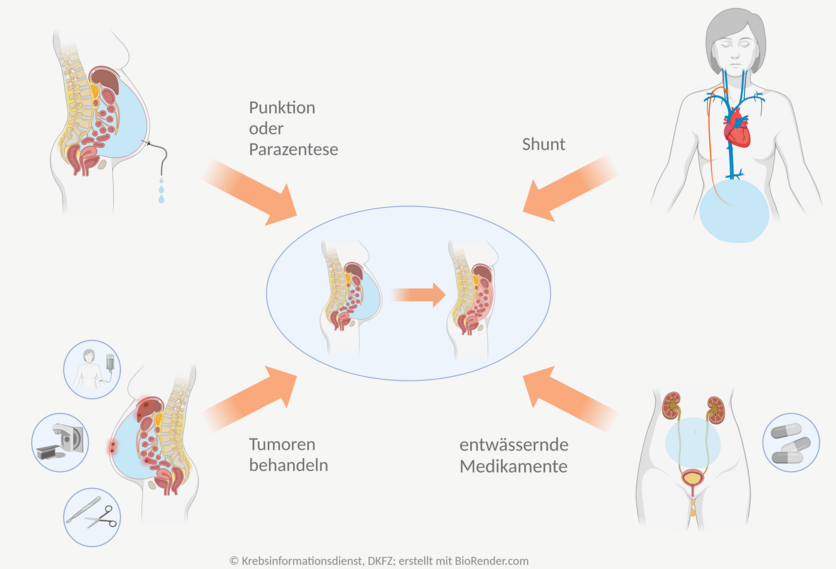 Behandlungsmöglichkeiten bei Aszites, © Krebsinformationsdienst, DKFZ; erstellt mit BioRender.com Schematische Übersicht über die Möglichkeiten, die Beschwerden bei einem Aszites zu lindern. Dies ist durch eine Punktion oder Parazentese, einen Shunt, Behandlung der Tumoren oder durch entwässernde Medikamente möglich.