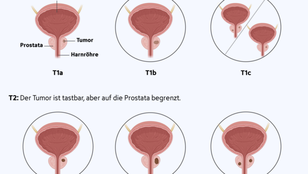 Grafische Darstellung der 6 Tumorstadien bei lokal begrenztem Prostatakrebs.