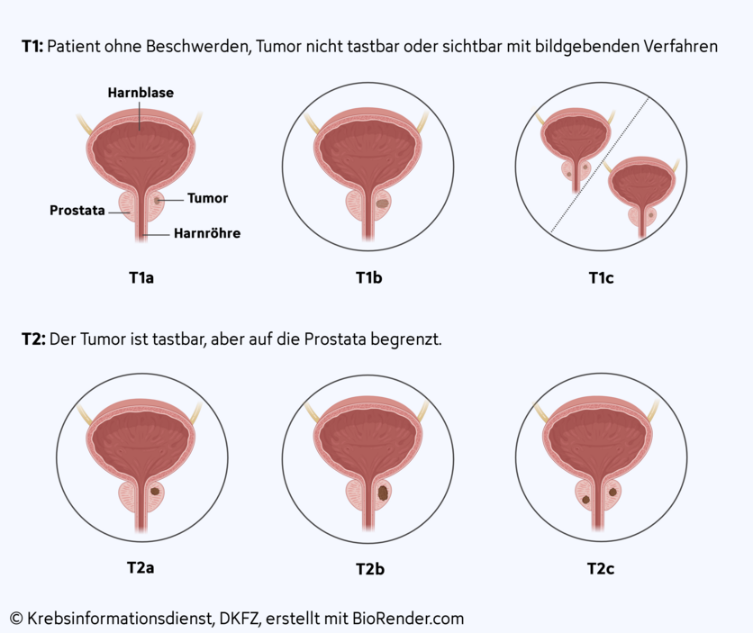 Tumorgröße und -ausdehnung bei lokal begrenztem Prostatakrebs, © Krebsinformationsdienst, DKFZ; erstellt mit Biorender.com Grafische Darstellung der 6 Tumorstadien bei lokal begrenztem Prostatakrebs.