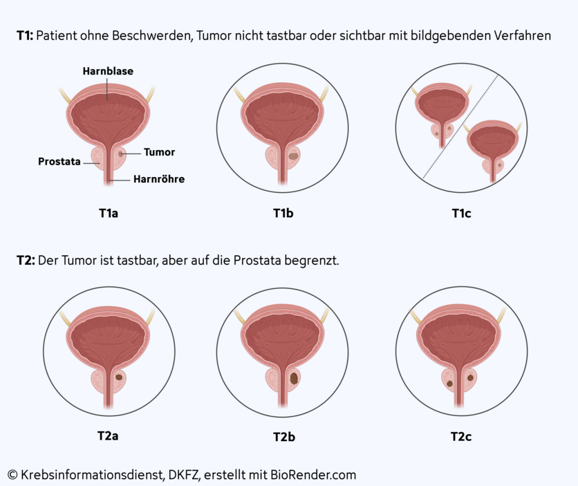 Tumorgröße und -ausdehnung bei lokal begrenztem Prostatakrebs, © Krebsinformationsdienst, DKFZ; erstellt mit Biorender.com Grafische Darstellung der 6 Tumorstadien bei lokal begrenztem Prostatakrebs.