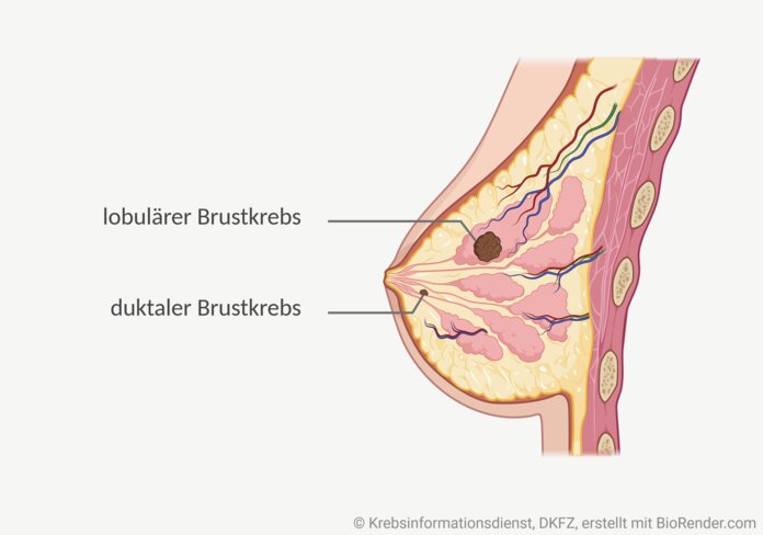 Lobulärer und ductaler Brustkrebs, © Krebsinformationsdienst, DKFZ; erstellt mir Biorender.com Grafische Darstellung einer weiblichen Brust mit 2 Tumoren, einer sitzt im Drüsenlappen, der andere in/an einem Milchgang.