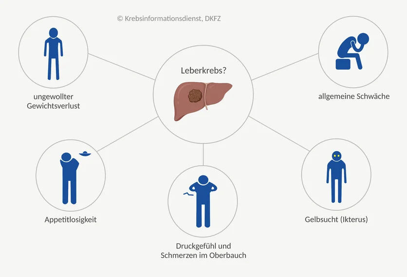 Symptome bei Leberkrebs , © Krebsinformationsdienst, DKFZ; erstellt mit Biorender.com Mindmap möglicher Symptome bei Leberkrebs: ungewollter Gewichtsverlust, Appetitlosigkeit, Druckgefühl und Schmerzen im Oberbauch, Gelbsucht (Ikterus) sowie allgemeine Schwäche.