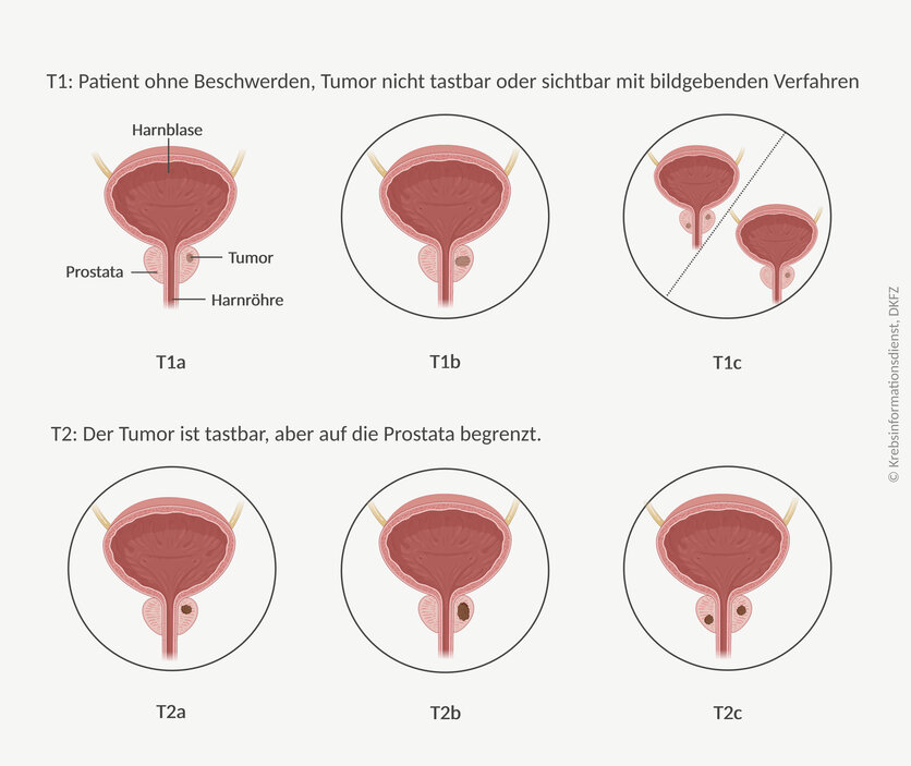 Tumorgröße und -ausdehnung bei lokal begrenztem Prostatakrebs, © Krebsinformationsdienst, DKFZ; erstellt mit Biorender.com Grafische Darstellung der 6 Tumorstadien bei lokal begrenztem Prostatakrebs.