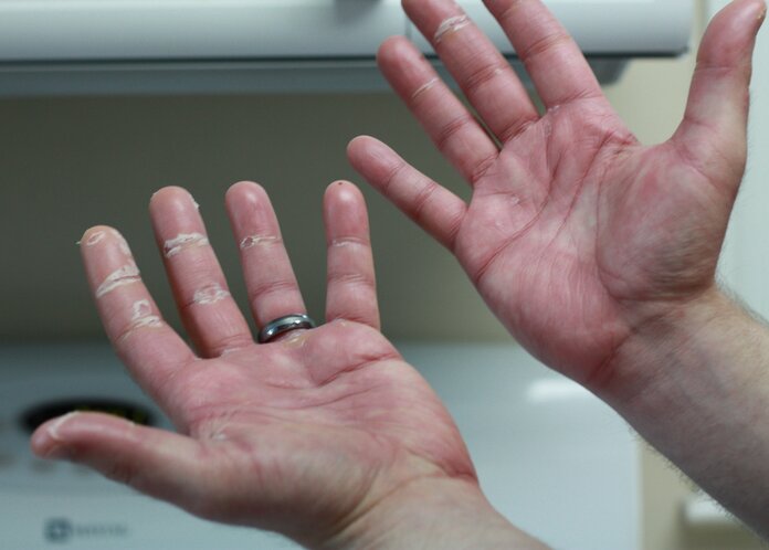 Hand-Fuß-Syndrom , © Lucid Smog, Wikimedia Commons Gerötete, schuppige Hände aufgrund eines Hand-Fuß-Syndroms