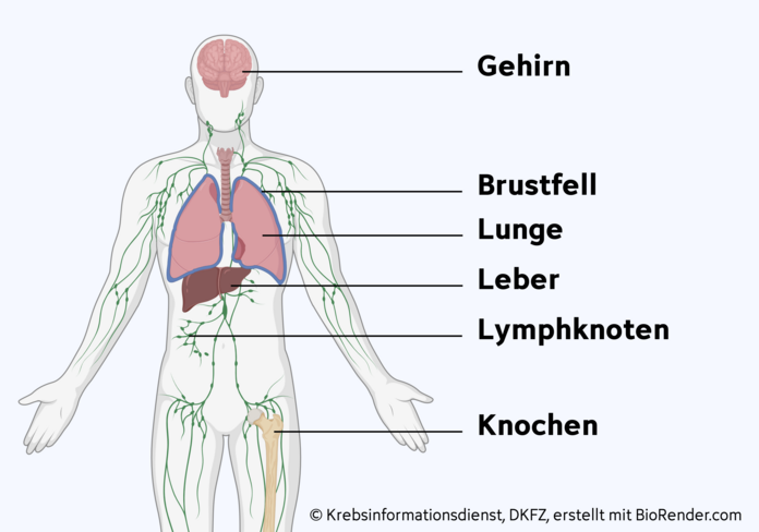 Anatomische Abbildung, die zeigt wo sich beim CUP-Syndrom häufig Metastasen bilden: im Gehirn, Brustfell, Lunge, Leber, Lymphknoten und Knochen.