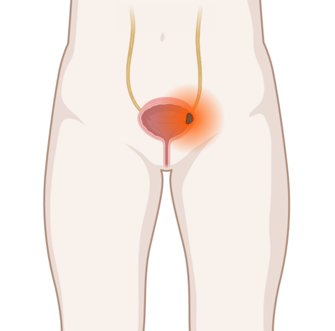 Schematische anatomische Darstellung der Harnblase mit leuchtendem Tumor