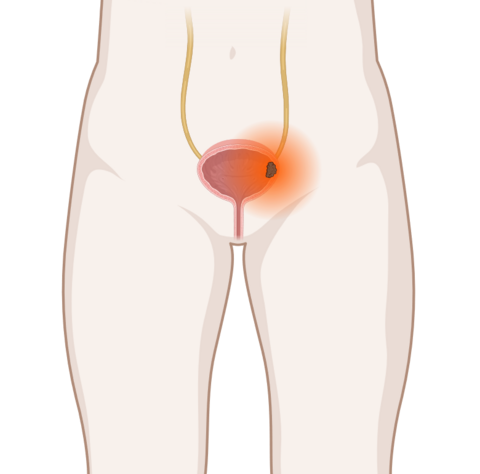 Blasenkrebs, © Krebsinformationsdienst, DKFZ; erstellt mit Biorender.com Schematische anatomische Darstellung der Harnblase mit leuchtendem Tumor