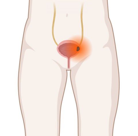 Schematische anatomische Darstellung der Harnblase mit leuchtendem Tumor