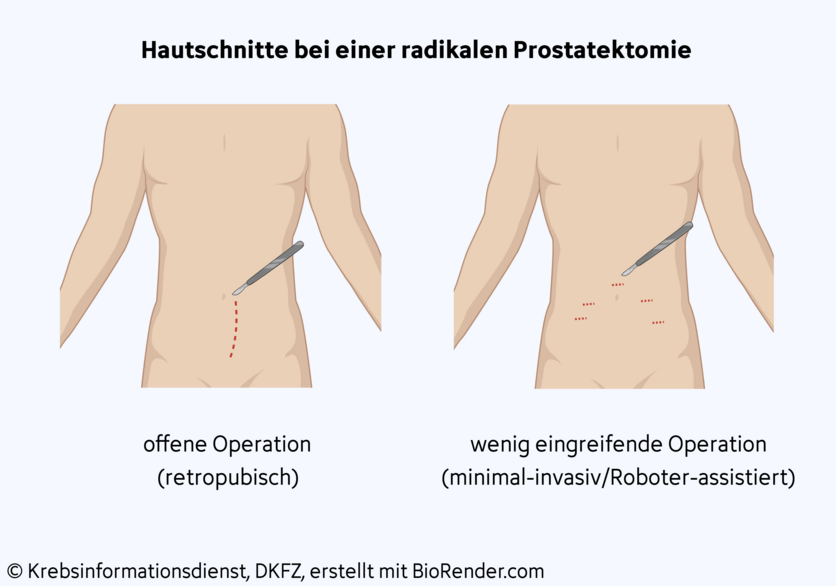 Operationstechniken bei einer radikalen Prostatektomie, © Krebsinformationsdienst, DKFZ; erstellt mit Biorender.com Grafische Darstellung der notwendigen Hautschnitte bei einer radikalen Prostatektomie: bei einer retropubischen Operation wird ein Längsschnitt zwischen Nabel und Schambein des Patienten gemacht. Bei einem wenig eingreifenden (minimal-invasiven) Vorgehen, wie der Roboter-assistierten OP, macht der Chirurg oder die Chirurgin mehrere kleine Schnitte in die Bauchdecke.