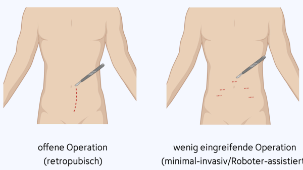Grafische Darstellung der notwendigen Hautschnitte bei einer radikalen Prostatektomie: bei einer retropubischen Operation wird ein Längsschnitt zwischen Nabel und Schambein des Patienten gemacht. Bei einem wenig eingreifenden (minimal-invasiven) Vorgehen, wie der Roboter-assistierten OP, macht der Chirurg oder die Chirurgin mehrere kleine Schnitte in die Bauchdecke.