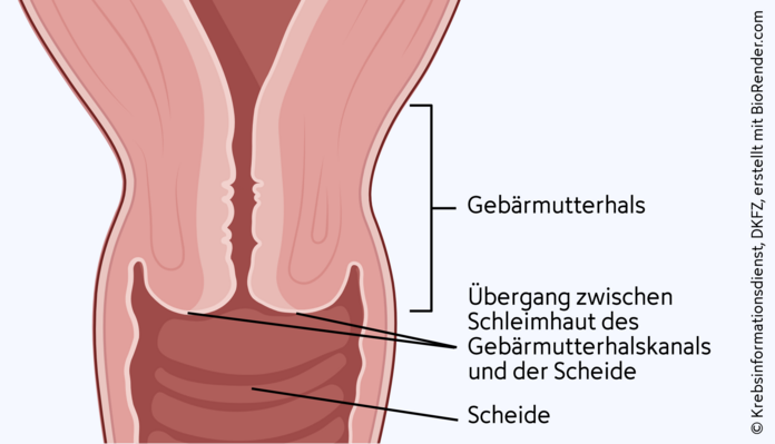 Schematische Darstellung des Übergangsbereichs der Schleimhaut von Scheide und Gebärmutterhalskanal.
