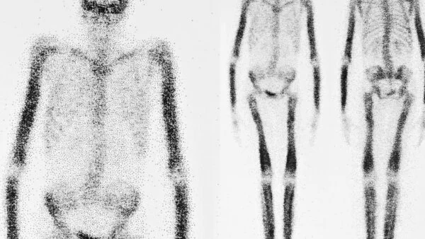 Schwarz-weiße, schemenhafte Darstellung eines Skeletts