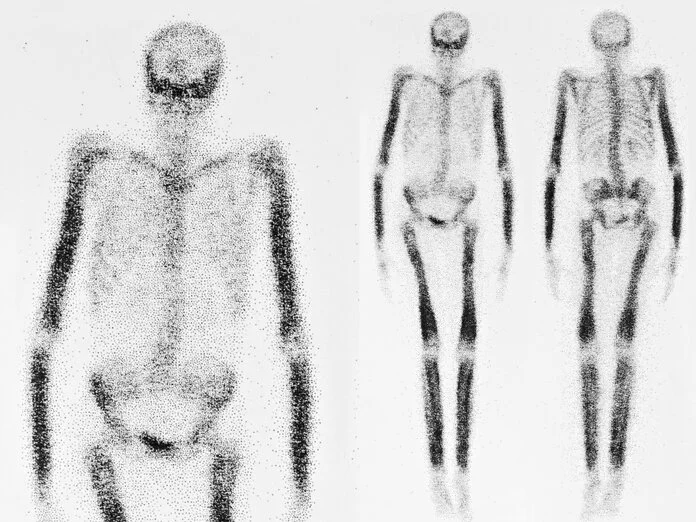 Skelettszintigramm, © Susan Law Cain, iStock Schwarz-weiße, schemenhafte Darstellung eines Skeletts