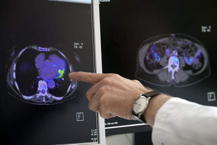 Ein Arzt deutet auf einen farbig markierten Bereich in einem CT-Bild, das ein Organ zeigt.