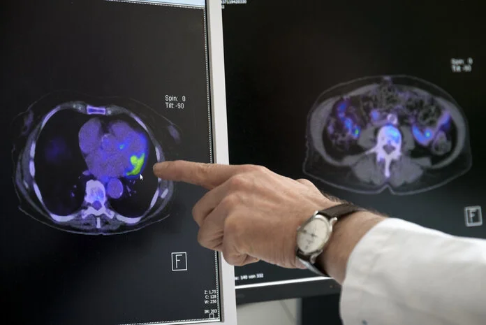 CT-Bild, © Krebsinformationsdienst, DKFZ; Foto: Tobias Schwerdt Ein Arzt deutet auf einen farbig markierten Bereich in einem CT-Bild, das ein Organ zeigt.