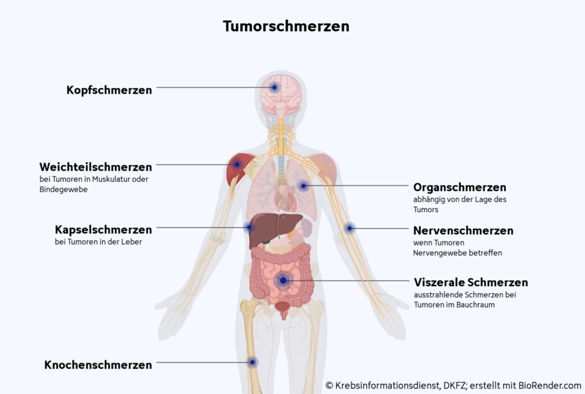 Anatomische Ansicht eines Menschen, an dem verschiedene Formen von Tumorschmerzen gekennzeichnet sind: Organschmerzen am Gehirn, Nervenschmerzen am Nerven des Armes, Viszerale Schmerzen im Magen-Darm-Trakt, Knochenschmerzen im Oberschenkelknochen, Kapselschmerzen in der Leber, Weichteilschmerzen im Schultermuskel.