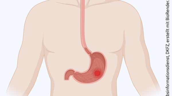 Silhouette eines Oberkörpers mit Magen und Speiseröhre. Im Magen befindet sich ein Tumor.