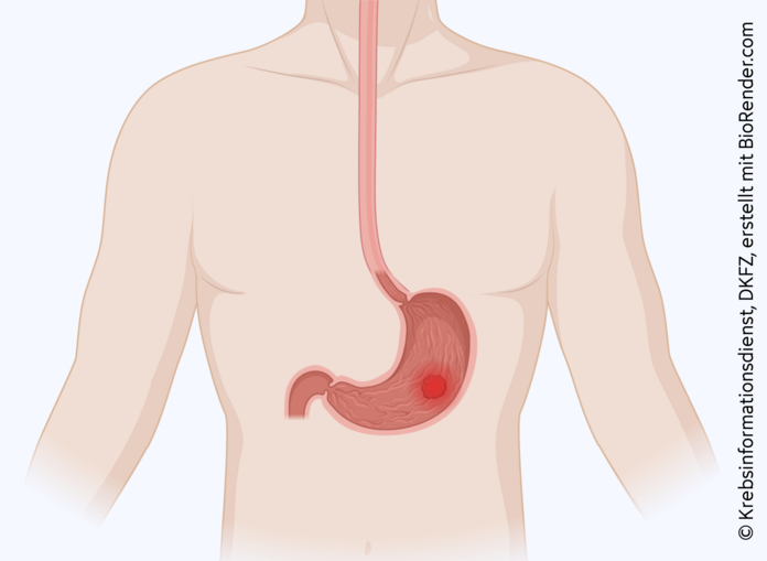 Silhouette eines Oberkörpers mit Magen und Speiseröhre. Im Magen befindet sich ein Tumor.